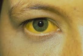 Understanding Hepatitis: A Silent Threat to Your Health