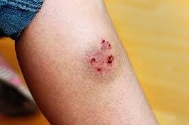Rabies Ends with Us: Awareness, Action, and Vaccination
